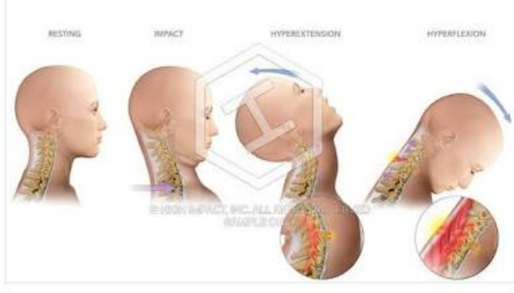 What is Whiplash and Scientifically What Causes It?